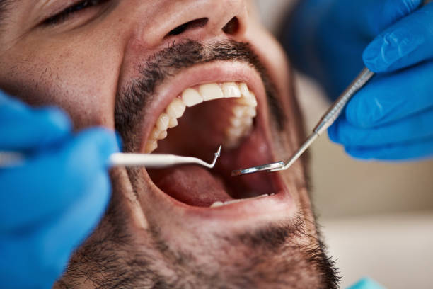Best Emergency Tooth Extraction in Hampton, SC